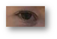 Alfie's eye  before they closed it permanently as a matter of policy